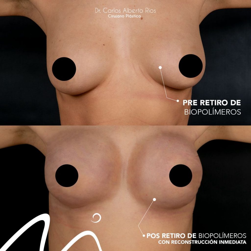 reconstruccion-senos-3