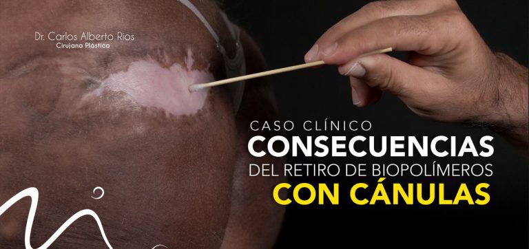 CONSECUENCIAS DEL RETIRO DE BIOPOLÍMERO CON CÁNULA