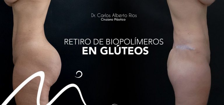 retiro de biopolimeros blog